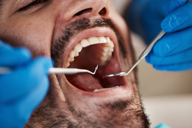 Best Emergency Dental Care for Broken or Chipped Teeth in Laguna Woods, CA